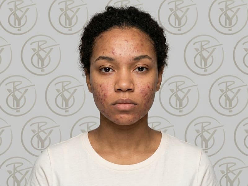 Acne Treatment — before