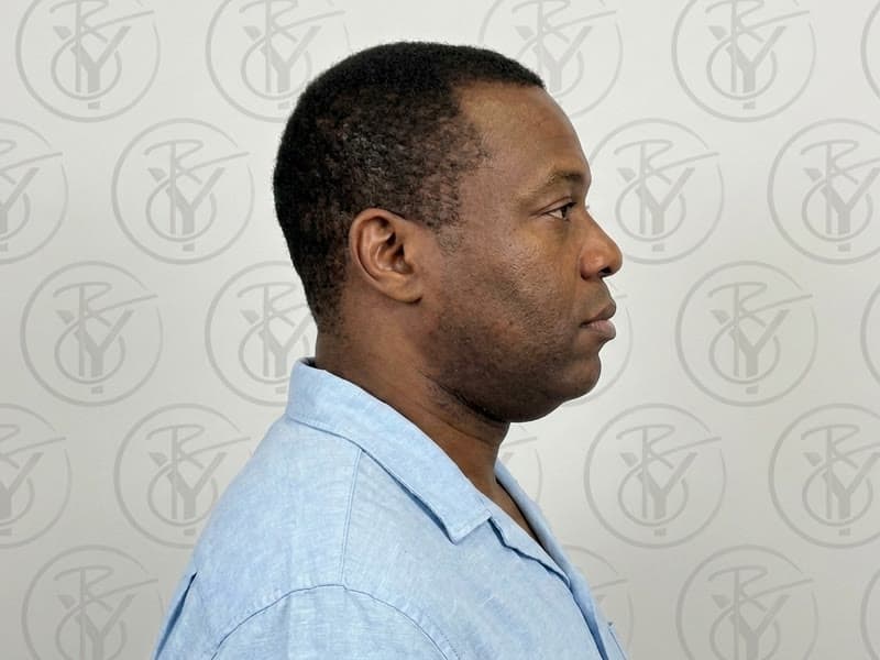 Kybella — before
