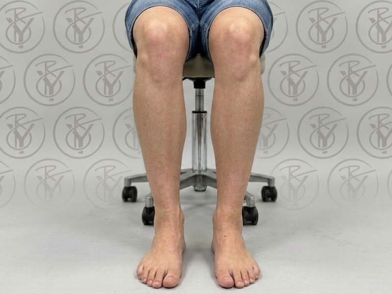 Laser Hair Removal — after