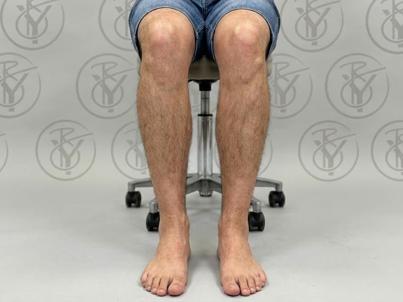Laser Hair Removal — before
