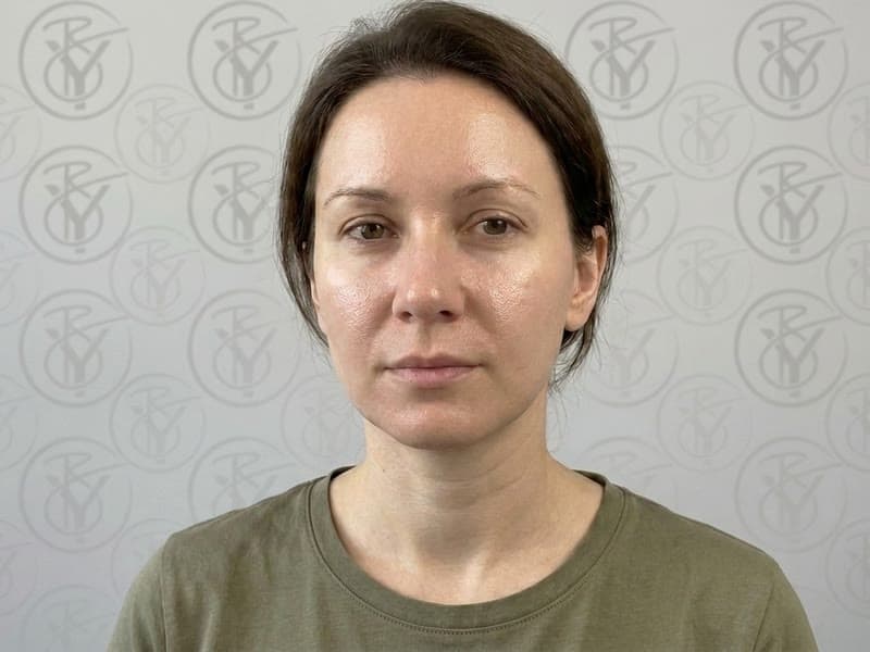 Microdermabrasion — after