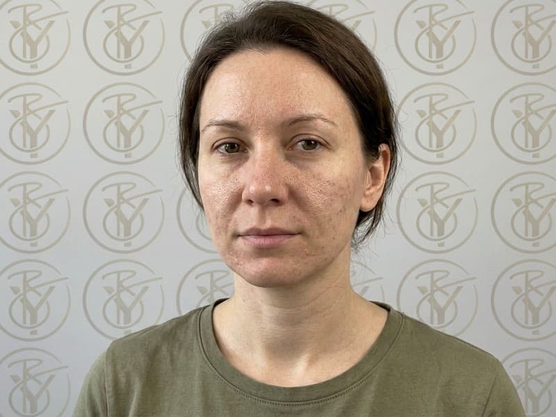 Microdermabrasion — before