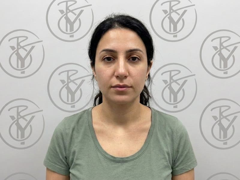Microneedling — after