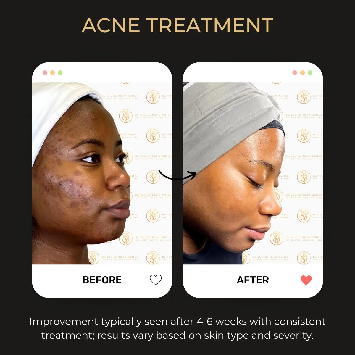Before and after acne treatment results at Be You Esthetic Suites.