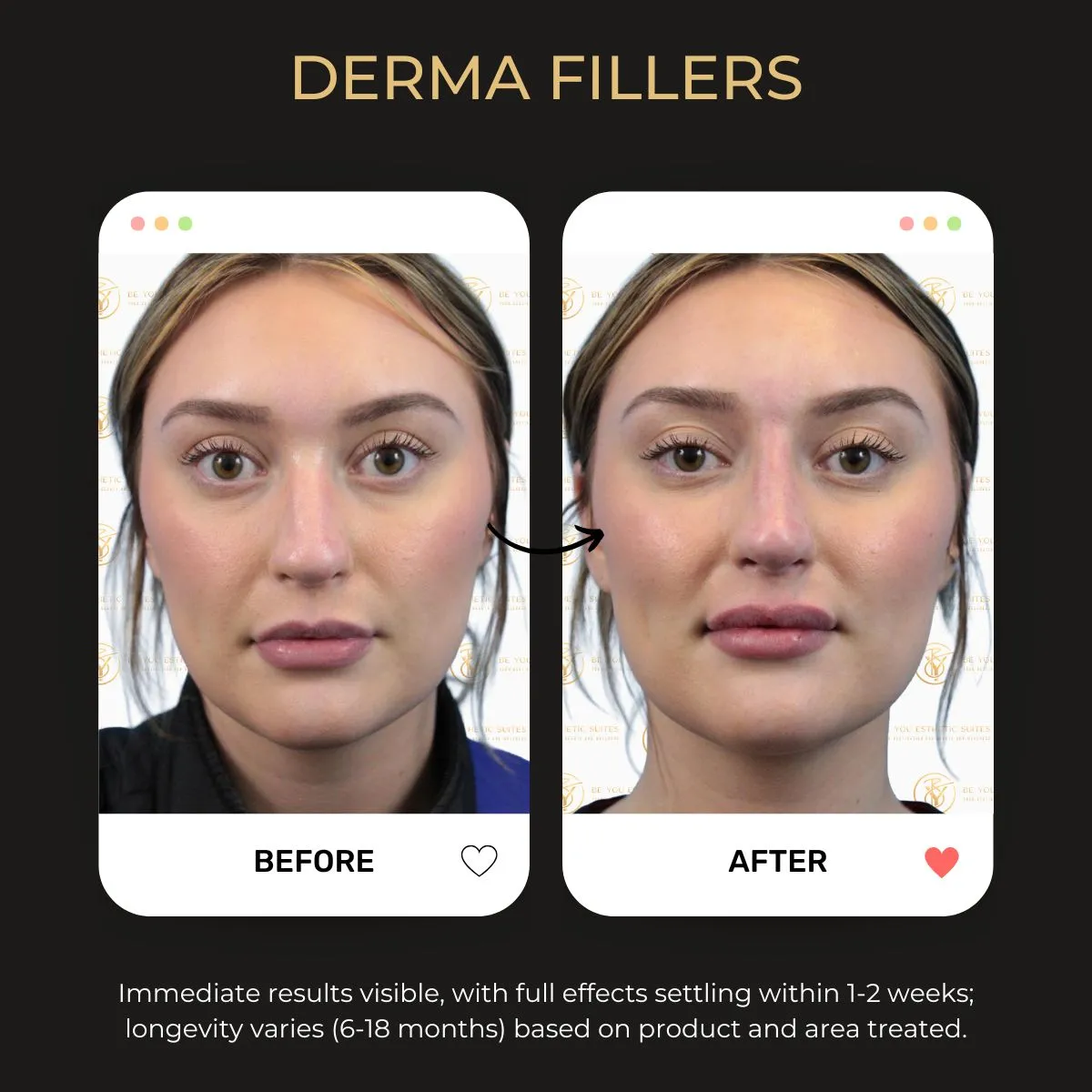 Before and after derma fillers at Be You Esthetic Suites.