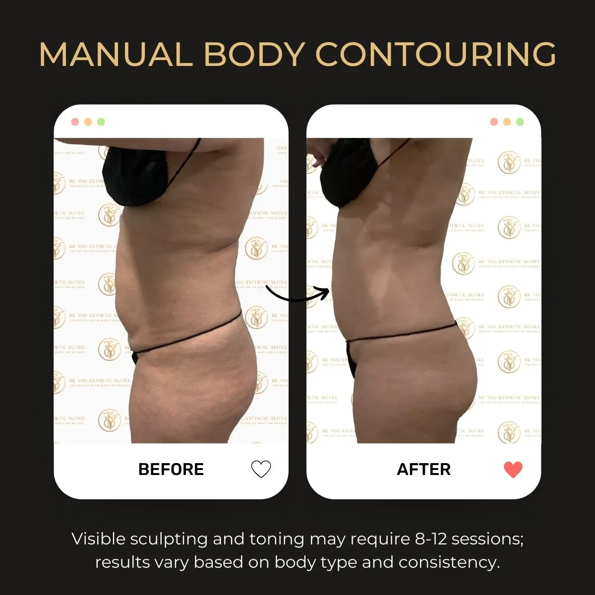Before and after manual body contouring results at Be You Esthetic Suites.