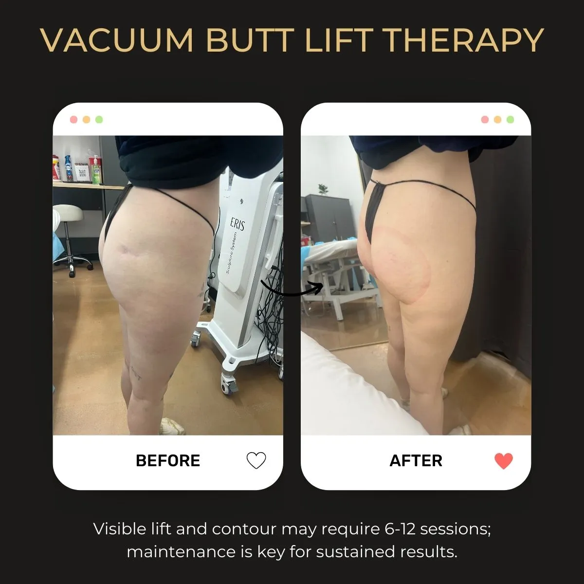 Before and after Vacuum BBL therapy results at Be You Esthetic Suites.