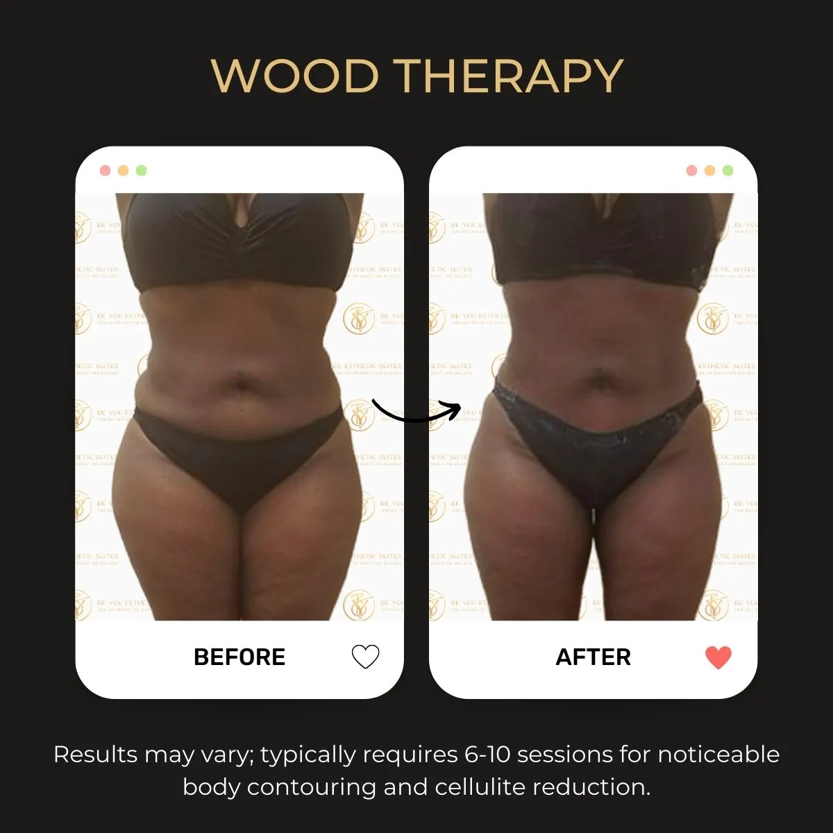 Before and after wood therapy body transformation at Be You Esthetic Suites.